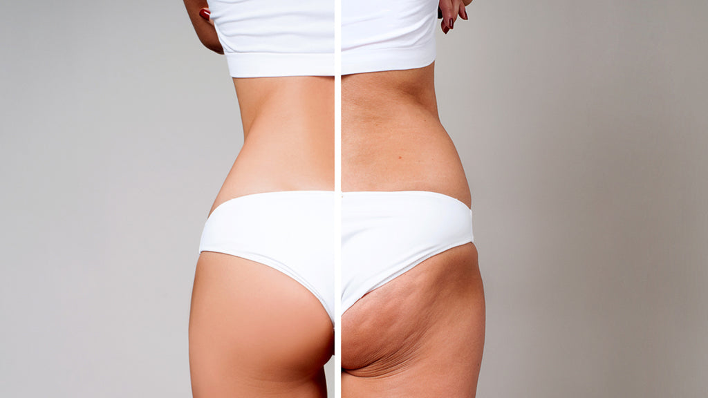 Geteiltes Bild einer Frau in Unterwäsche: Links glatte Haut an Oberschenkel/Po, rechts derselbe Bereich mit sichtbarer Cellulite. Zeigt den Unterschied zwischen glatter Haut und Haut mit Cellulite.